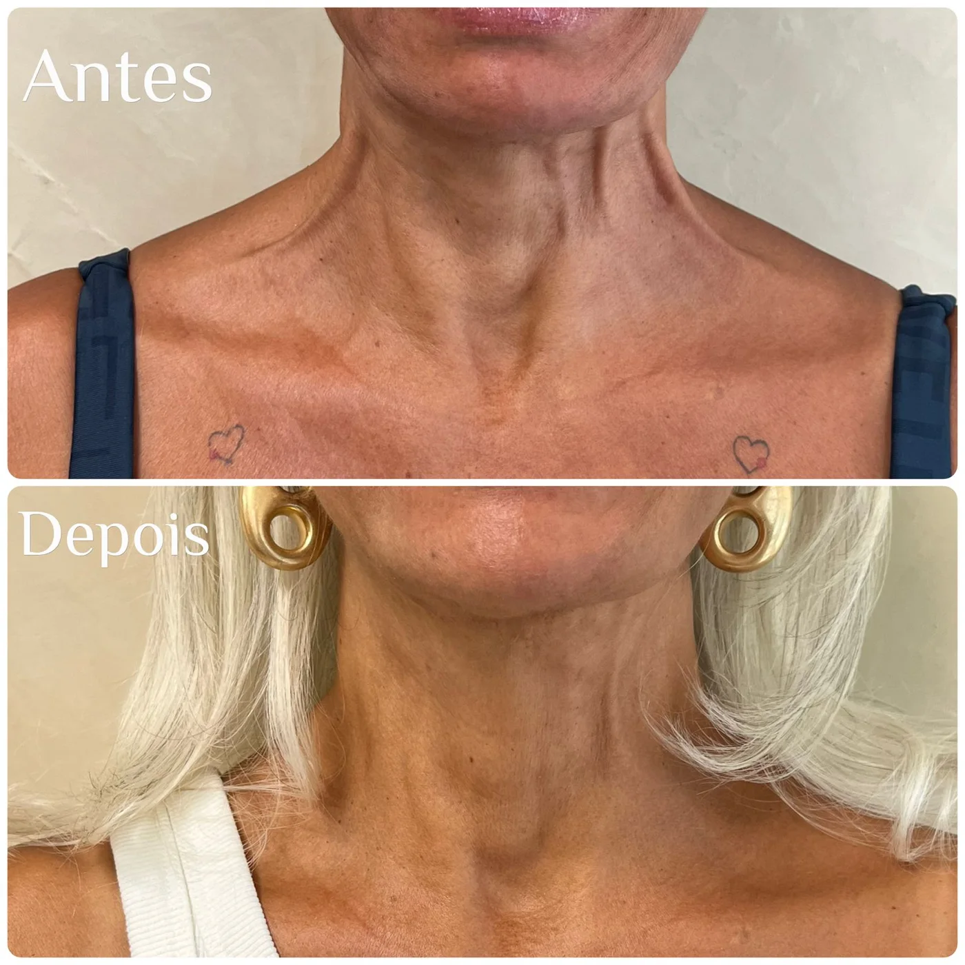 Registro real de botox para lifting Nefertiti na região do pescoço e linha mandibular