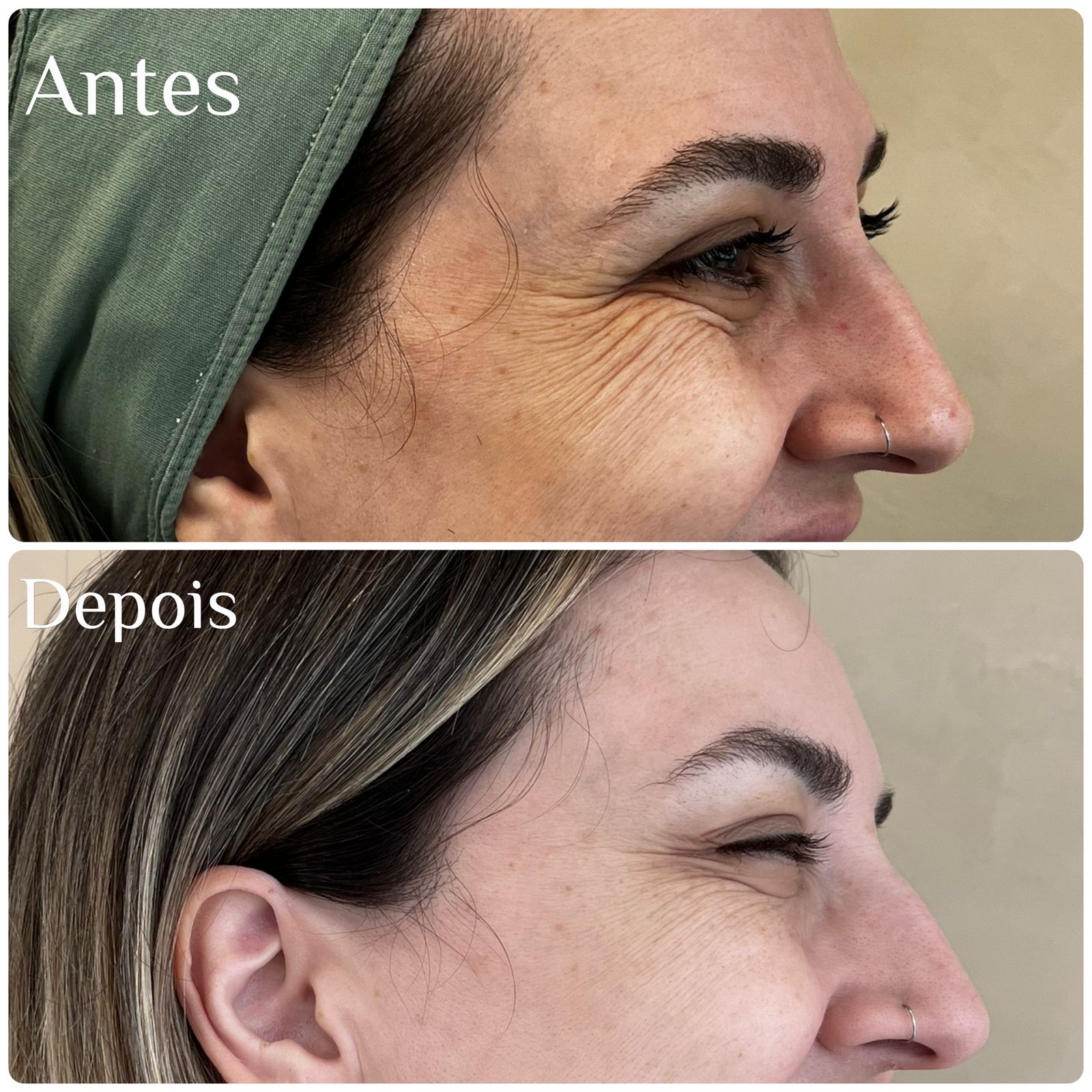 Antes e depois de toxina botulínica na região dos olhos