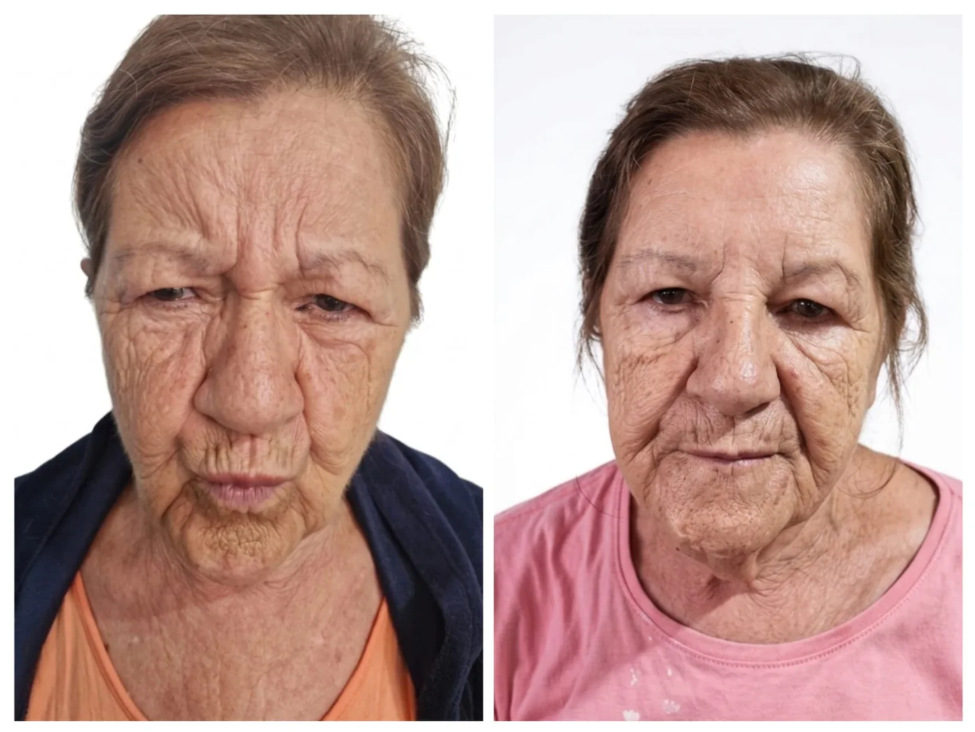 Registro comparativo de toxina botulínica em linhas de expressão